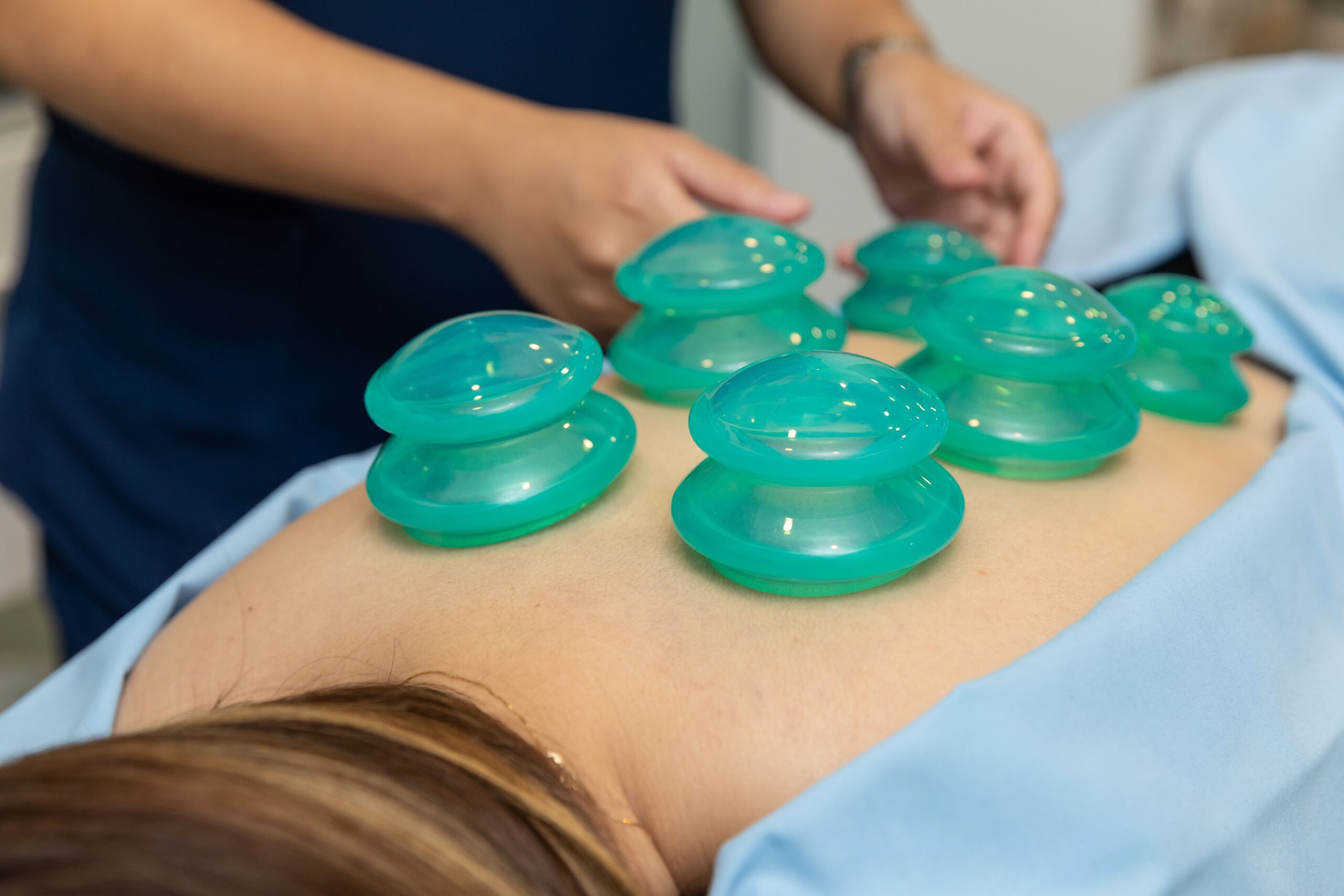 Woman receiving cupping therapy in Dubai