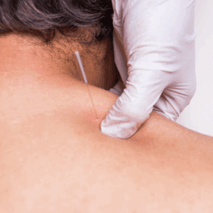 Man receiving dry needing treatment