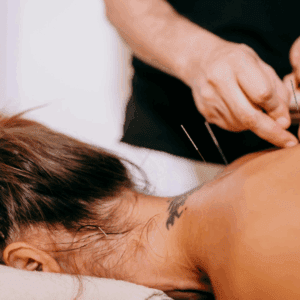 woman receiving dry needling treatment