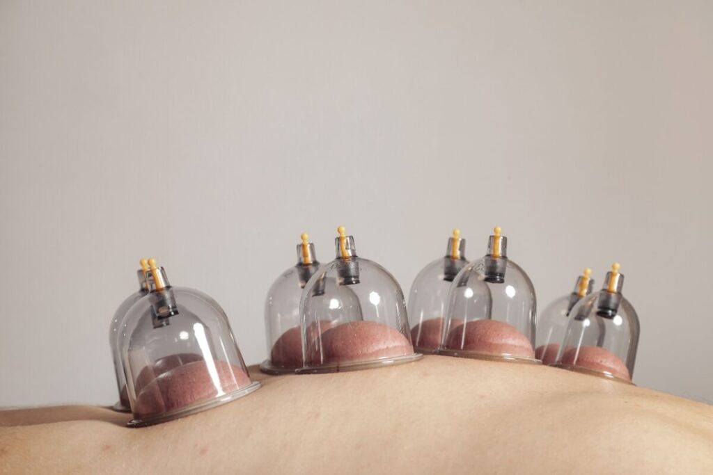 Cupping therapy